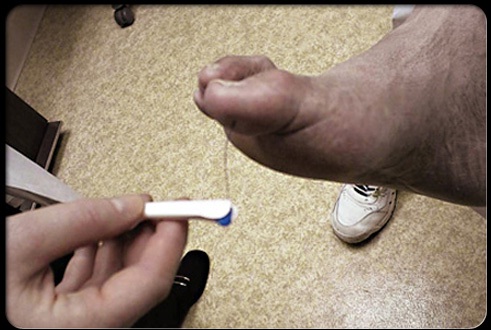 Ảnh hưởng bất lợi do Đái tháo đường lên bàn chân - Biến chứng tiểu đường