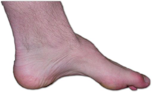 Biến chứng bàn chân Charcot trong bệnh tiểu đường