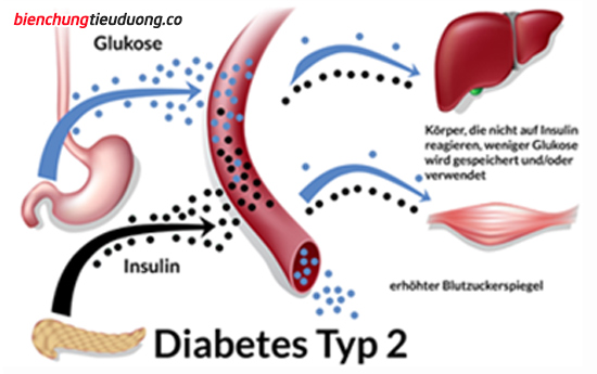Tăng nguy cơ tiểu đường typ 2 khi dùng thuốc statin liều cao