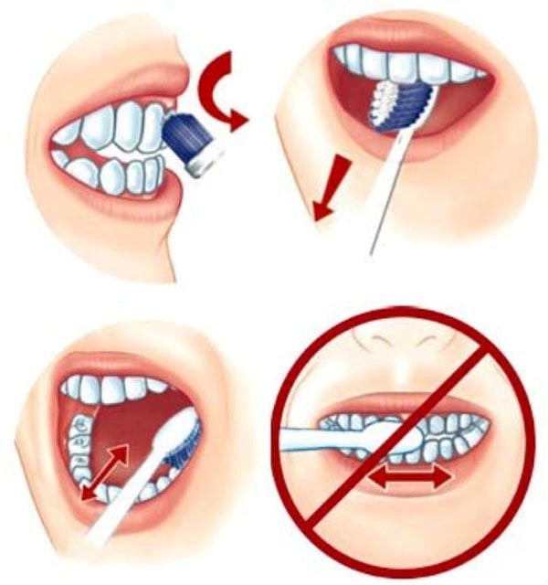  Chải răng không đúng cách gây chảy máu chân răng