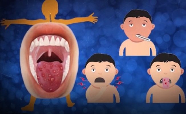 Loét miệng là một trong những triệu chứng của bệnh tay chân miệng