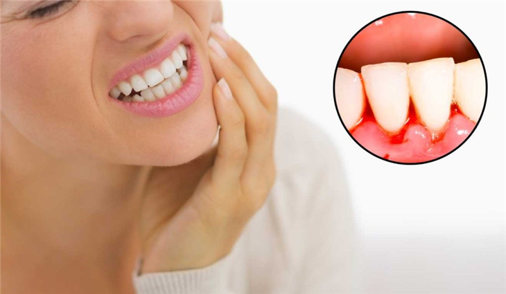 Chảy máu chân răng là bệnh gì?