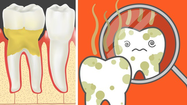 Bệnh viêm nướu răng gây hơi thở có mùi