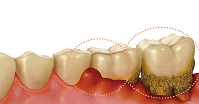 Sưng nướu răng có mủ là dấu hiệu bệnh viêm lợi trùm có mủ