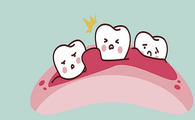 Viêm chân răng là bệnh gì?