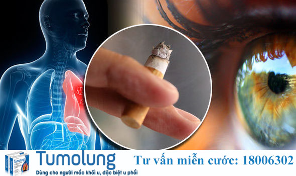 Thuốc lá là một trong những tác nhân nguy hiểm gây u phế quản thùy trên phổi phải