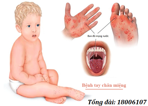 Hình ảnh bệnh chân tay miệng ở trẻ em 