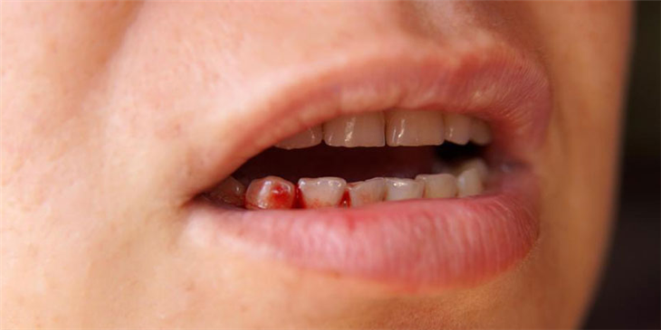 Chảy máu chân răng là bệnh gì?