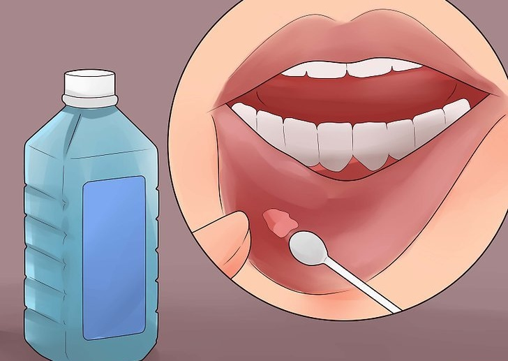 Nhiệt miệng là bệnh gì?