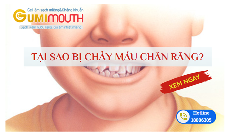 Răng mọc lệch là nguyên nhân gây chảy máu chân răng