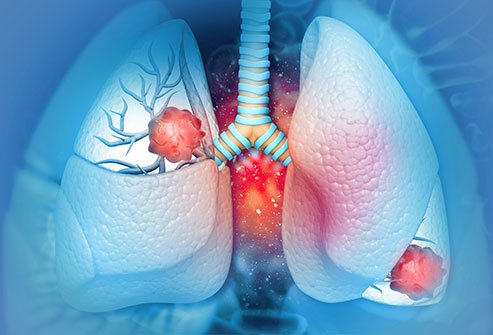 Ung thư phổi giai đoạn 4 gây nhiều triệu chứng khác nhau