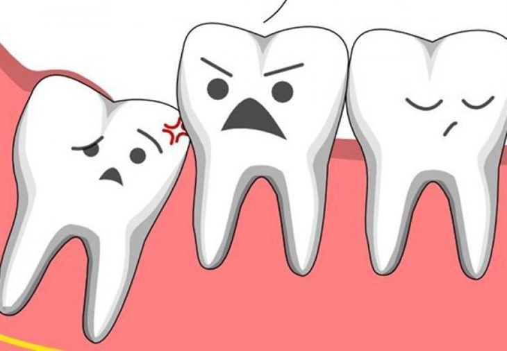 Nhức răng xuất hiện khi răng khôn mọc lên