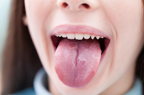 Nhiệt lưỡi là bệnh gì?