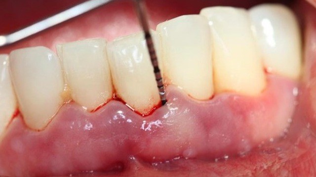 Tổn thương do viêm quanh răng