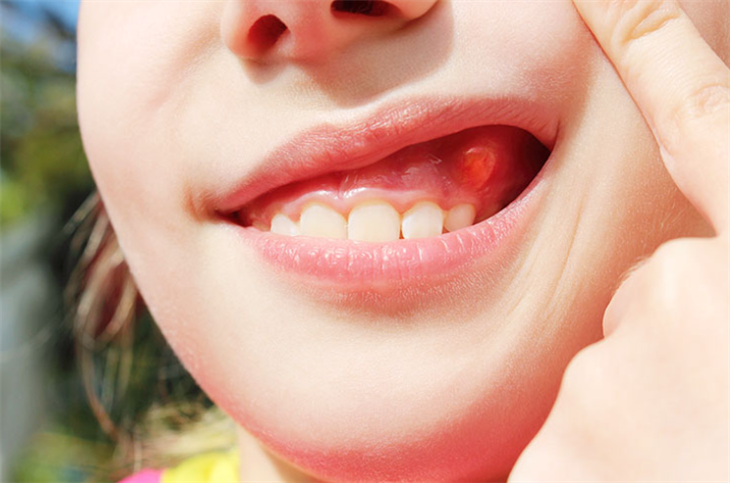Viêm chân răng có mủ là bệnh gì?
