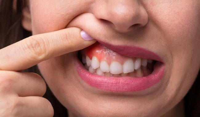 Viêm chân răng là bệnh lý răng miệng hay gặp