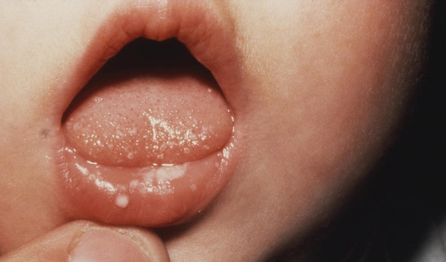 Dấu hiệu nhận biết nhiệt miệng ở trẻ sơ sinh