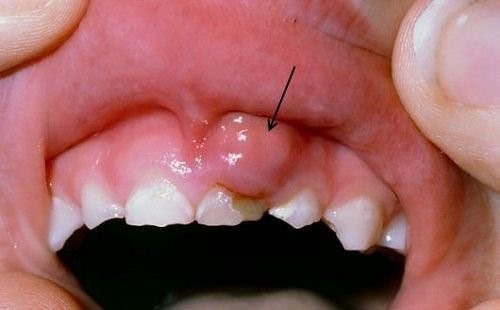 Biểu hiện viêm nướu răng ở trẻ em
