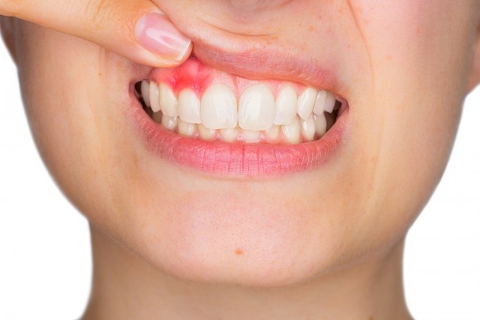 Tình trạng viêm nướu răng hàm trên