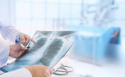 Chụp X-quang phổi giúp ghi lại hình ảnh của phổi