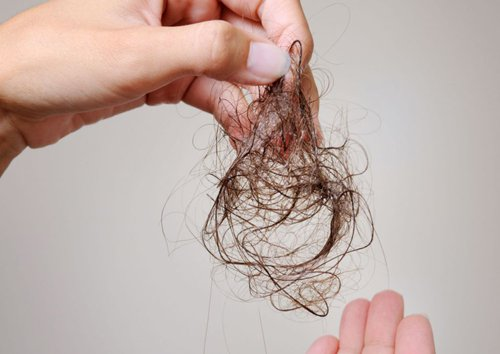   Rụng tóc là triệu chứng của bệnh á sừng da đầu