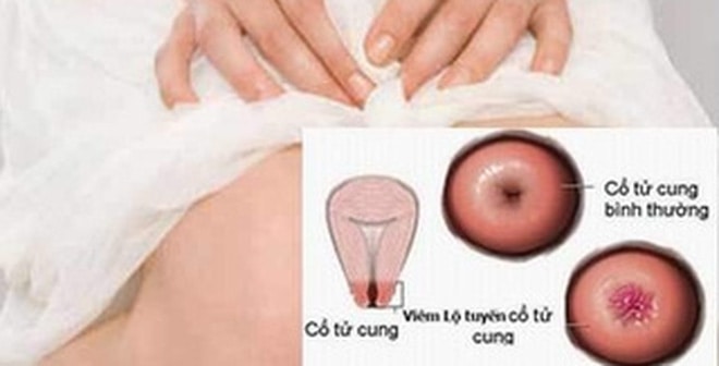 Viêm lộ tuyến cổ tử cung gây vô sinh, sảy thai ở nữ giới