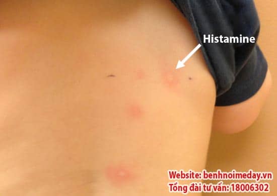 Histamin là nguyên nhân gây dị ứng mề đay
