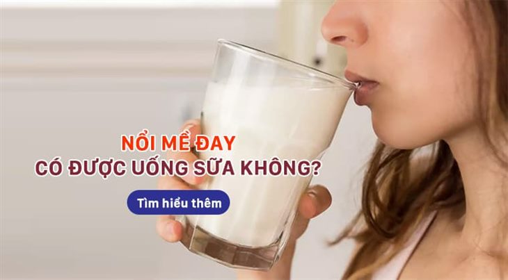 Nổi mề đay có được uống sữa không? Thông tin hữu ích bạn cần biết