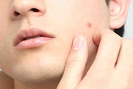 cách trị dị ứng da mặt bằng nha đam