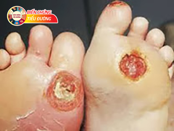 Nhiễm trùng bàn chân ở người bệnh tiểu đường