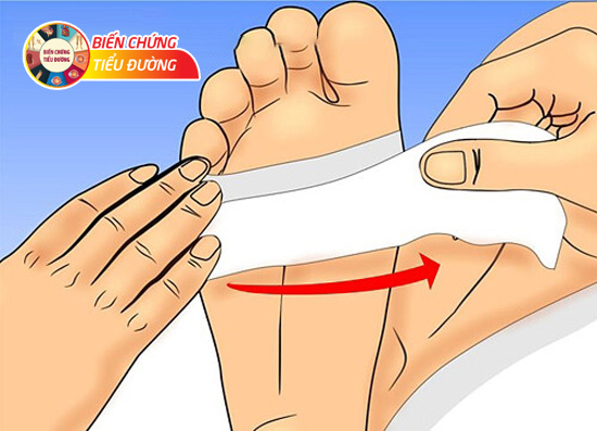 Cần chăm sóc tốt bàn chân để tránh đoạn chi