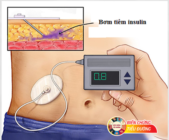 Bơm tiêm insulin khiến người bệnh kiểm soát liều lượng và thời gian tiêm dễ dàng