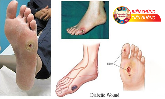 Nhiễm trùng bàn chân do tiểu đường có thể bắt đầu từ tình trạng da khô, dày móng
