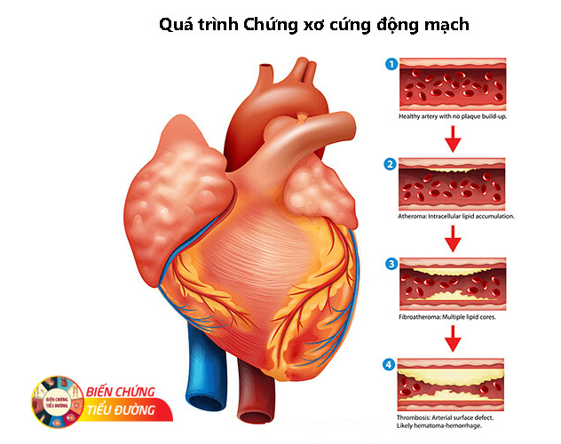 Các giai đoạn hình thành và phát triển mảng xơ vữa động mạch