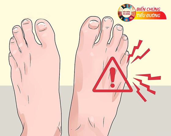 Cảm giác ngứa ran là dấu hiệu cảnh báo biến chứng bàn chân của bệnh tiểu đường