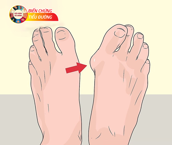 Dị dạng ở bàn chân, ngón chân làm tăng nguy cơ biến chứng loét chân tiểu đường