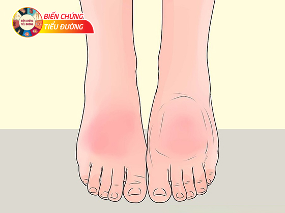 Tổn thương da, nhiễm trùng dẫn đến nhiều biến chứng bàn chân của bệnh tiểu đường