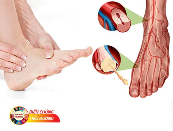Tê bì chân tay là dấu hiệu ban đầu của biến chứng thần kinh do bệnh tiểu đường