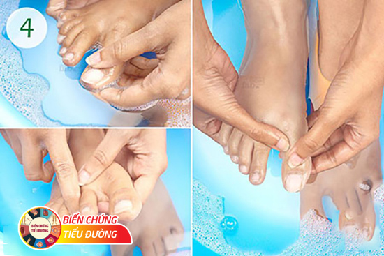 Vệ sinh chân hàng ngày sẽ giúp bạn phòng ngừa biến chứng bàn chân của bệnh tiểu đường