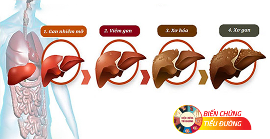 4 giai đoạn của biến chứng tiểu đường trên gan.