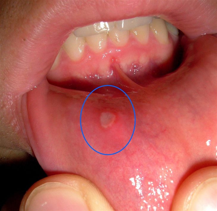 Bệnh viêm loét miệng gây đau đớn cho người bệnh