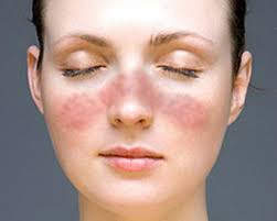 Điều trị bệnh lupus gặp rất nhiều khó khăn