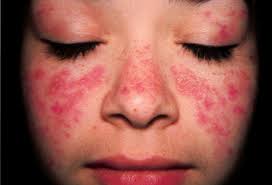 Bệnh lupus ban đỏ là gì?