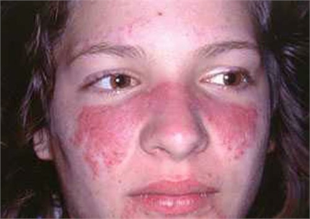 Nữ giới là đối tượng hay mắc phải bệnh lupus ban đỏ