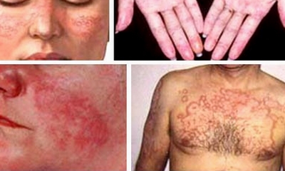 Lupus ban đỏ gây ra nhiều tổn thương