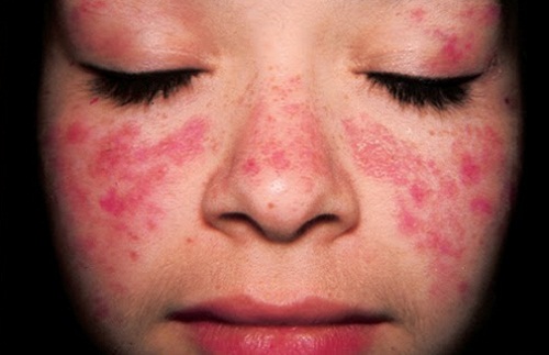 Triệu chứng bệnh lupus ban đỏ