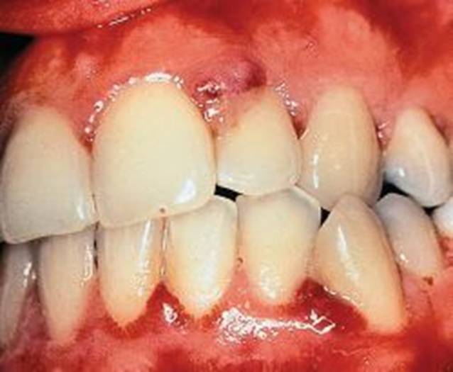 Vi khuẩn là nguyên nhân gây hại cho răng chủ yếu
