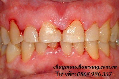 Viêm nha chu có thể gây mất răng sớm