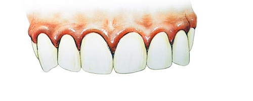 Viêm lợi là bệnh răng miệng thường gặp nhất