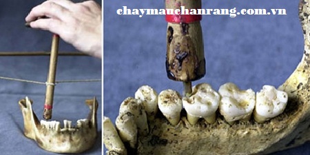người cổ đại về chăm sóc răng lợi, chảy máu chân răng 1